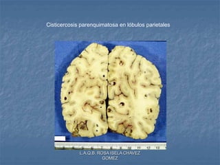 L.A.Q.B. ROSA ISELA CHAVEZ
GOMEZ
Cisticercosis parenquimatosa en lóbulos parietales
 