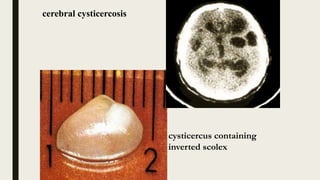 cysticercus containing
inverted scolex
cerebral cysticercosis
 