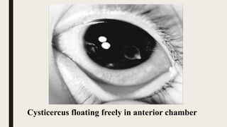 Cysticercus floating freely in anterior chamber
 