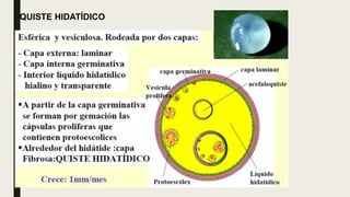 QUISTE HIDATÍDICO
 
