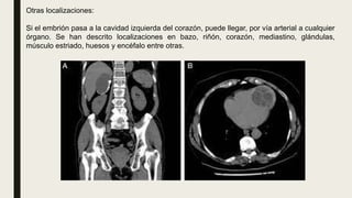 Otras localizaciones:
Si el embrión pasa a la cavidad izquierda del corazón, puede llegar, por vía arterial a cualquier
órgano. Se han descrito localizaciones en bazo, riñón, corazón, mediastino, glándulas,
músculo estriado, huesos y encéfalo entre otras.
 