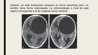 Cerebro, en esta localización tampoco se forma adventicia pero, en
cambio, tiene forma redondeada. La sintomatología a nivel de este
órgano corresponde a la de cualquier tumor cerebral.
 