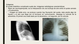 Imágenes
El quiste hidatídico complicado suele dar, imágenes radiológicas características:
- Signo de neumoperiquiste, es la interposición de una burbuja de aire entre el quiste cerrado
y la adventicia.
- - Imagen en doble arco, se produce cuando hay fisuración del quiste, éste pierde algo de
líquido y el aire que llega por el bronquio en comunicación, despega la cutícula de la
adventicia. El primer arco está dado por la adventicia, y el segundo, por la cutícula.
 