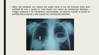 - Signo del camalote, por ruptura del quiste hacia la luz del bronquio entra gran
cantidad de aire y queda un nivel líquido con restos de membranas flotantes. -
Imagen poligonal o de membranas encarceladas, se observa cuando el quiste ha
perdido todo el líquido y sólo quedan las membranas retenidas.
 