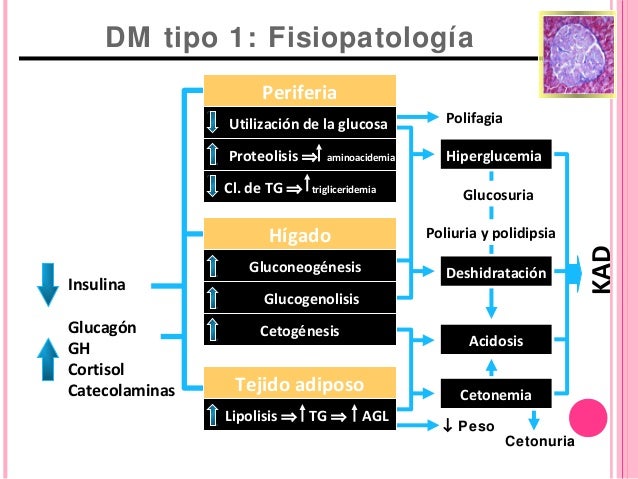Cetoacidosis diabética en pediatría Cetoacidosis diabética en pediatría