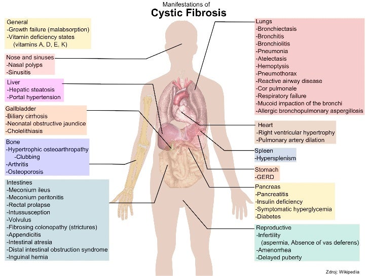 Cysticka Fibroza A Trombofilni Mutace