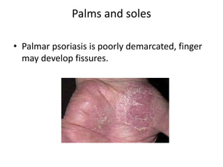 Palms and soles
• Palmar psoriasis is poorly demarcated, finger
may develop fissures.
 