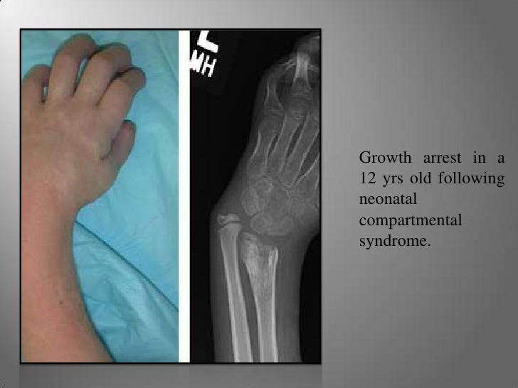 3 A’S Of Pediatric Compartment syndrome