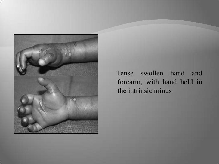 3 A’S Of Pediatric Compartment syndrome