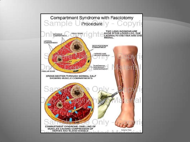 3 A’S Of Pediatric Compartment syndrome