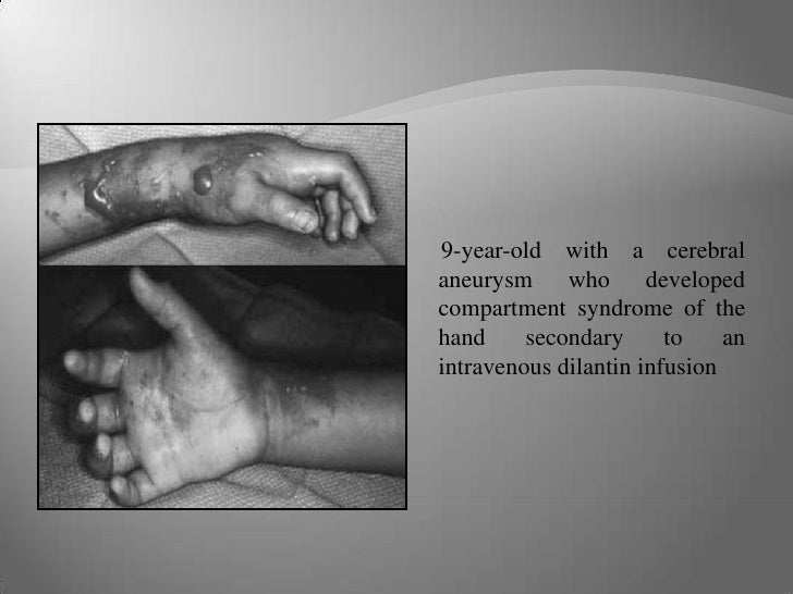 3 A’S Of Pediatric Compartment syndrome