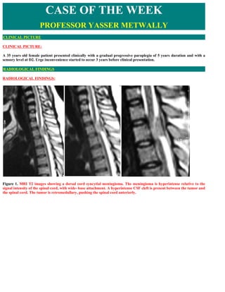 CASE OF THE WEEK
                      PROFESSOR YASSER METWALLY
CLINICAL PICTURE

CLINICAL PICTURE:

A 35 years old female patient presented clinically with a gradual progressive paraplegia of 5 years duration and with a
sensory level at D2. Urge inconvenience started to occur 3 years before clinical presentation.

RADIOLOGICAL FINDINGS

RADIOLOGICAL FINDINGS:




Figure 1. MRI T2 images showing a dorsal cord syncytial meningioma. The meningioma is hyperintense relative to the
signal intensity of the spinal cord, with wide- base attachment. A hyperintense CSF cleft is present between the tumor and
the spinal cord. The tumor is retromedullary, pushing the spinal cord anteriorly.
 