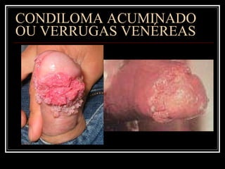 CONDILOMA ACUMINADO  OU VERRUGAS VENÉREAS 