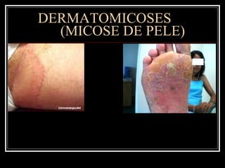 DERMATOMICOSES  (MICOSE DE PELE) 