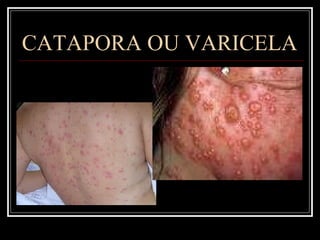 CATAPORA OU VARICELA 