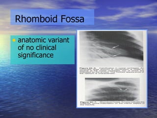 Rhomboid Fossa anatomic variant of no clinical significance 