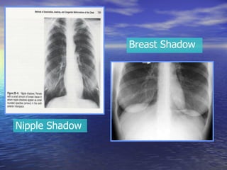 Nipple Shadow Breast Shadow 