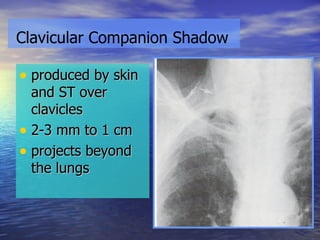 produced by skin and ST over clavicles 2-3 mm to 1 cm projects beyond the lungs Clavicular Companion Shadow 