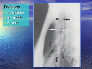 Divisions  A- anterior B- middle C- post 