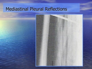 Mediastinal Pleural Reflections 