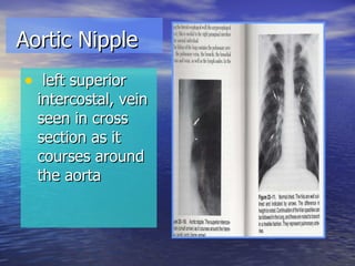Aortic Nipple left superior intercostal, vein seen in cross section as it courses around the aorta 