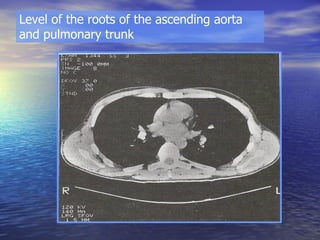 Level of the roots of the ascending aorta and pulmonary trunk  