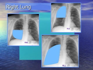 Right Lung  