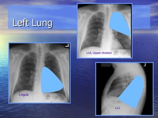 Left Lung 