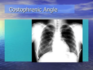 Costophrenic Angle 