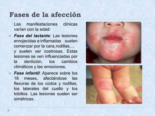 Fases de la afección	Las manifestaciones clínicas varían con la edad:Fase del lactante: Las lesiones enrojecidas e	inflamadas suelen comenzar por la cara,	rodillas,... y suelen ser costrosas. Estas lesiones se ven influenciadas por la dentición, los cambios climáticos y las emociones.Fase infantil: Aparece sobre los 18 meses, afectándose las flexuras de los codos y rodillas, los laterales del cuello y los tobillos. Las lesiones suelen ser simétricas.