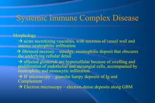 Systemic Immune Complex Disease Morphology    acute necrotizing vasculitis, with necrosis of vessel wall and intense neutrophilic infiltration    fibrinoid necrosis – smudgy, eosinophilic deposit that obscures the underlying cellular detail    affected glomeruli are hypercellular because of swelling and proliferation of endothelial and mesangial cells, accompanied by neutrophilic and monocytic infiltration    IF microscopy – granular lumpy deposits of Ig and Complement    Electron microscopy – electron-dense deposits along GBM 