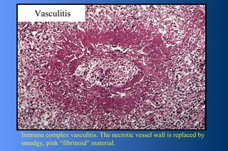 Vasculitis Immune complex vasculitis. The necrotic vessel wall is replaced by smudgy, pink “fibrinoid” material. 