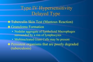 Type IV Hypersensitivity Delayed Type  ♣  Tuberculin Skin Test (Mantoux Reaction) ♣  Granuloma Formation Nodular aggregate of Epithelioid Macrophages surrounded by a rim of lymphocytes Multinucleated Giant Cells may be present ♣  Persistent organisms that are poorly degraded (tuberculosis) 
