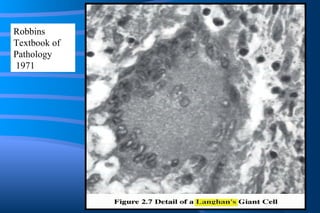 Langhan’s Giant Cell Picture Robbins Textbook of Pathology 1971 