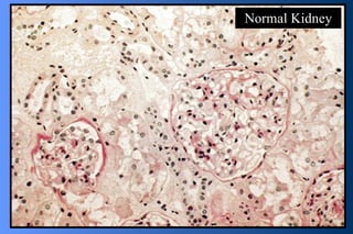Normal Kidney 