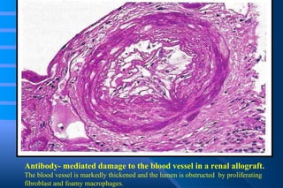 Antibody- mediated damage to the blood vessel in a renal allograft.  The blood vessel is markedly thickened and the lumen is obstructed  by proliferating fibroblast and foamy macrophages. 