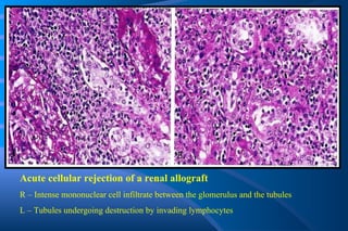 Acute cellular rejection of a renal allograft R – Intense mononuclear cell infiltrate between the glomerulus and the tubules L – Tubules undergoing destruction by invading lymphocytes 