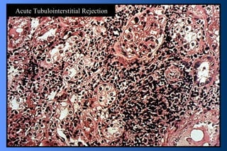 Acute Tubulointerstitial Rejection 