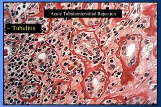 Acute Tubulointerstitial Rejection Tubulitis 