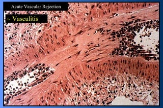 Acute Vascular Rejection Vasculitis 