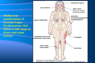 Multisystem manifestations of Systemic Lupus Erythematosus. SLE affects a wide range of tissues and organ systems 