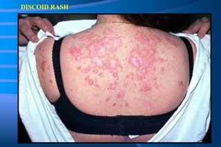 DISCOID RASH 
