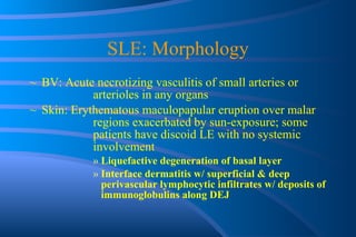 SLE: Morphology BV: Acute necrotizing vasculitis of small arteries or  arterioles in any organs Skin: Erythematous maculopapular eruption over malar  regions exacerbated by sun-exposure; some  patients have discoid LE with no systemic  involvement Liquefactive degeneration of basal layer Interface dermatitis w/ superficial & deep perivascular lymphocytic infiltrates w/ deposits of immunoglobulins along DEJ 