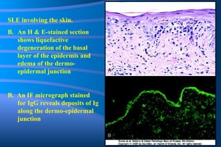 SLE involving the skin. An H & E-stained section shows liquefactive degeneration of the basal layer of the epidermis and edema of the dermo-epidermal junction B.  An IF micrograph stained for IgG reveals deposits of Ig along the dermo-epidermal junction 