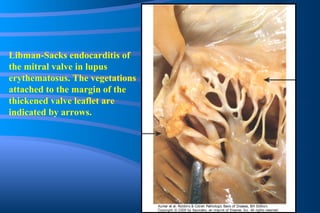 Libman-Sacks endocarditis of the mitral valve in lupus erythematosus. The vegetations attached to the margin of the thickened valve leaflet are indicated by arrows. 