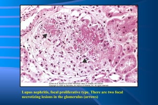 Lupus nephritis, focal proliferative type. There are two focal necrotizing lesions in the glomerulus (arrows) 