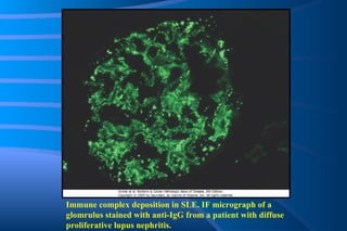 Immune complex deposition in SLE. IF micrograph of a glomrulus stained with anti-IgG from a patient with diffuse proliferative lupus nephritis. 