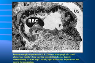 Immune complex deposition in SLE. Electron micrograph of a renal glomerular capillary loop showing subendothelial dense deposits corresponding to “wire loops” seen by light microscopy. Deposits are also seen in the mesangium. 