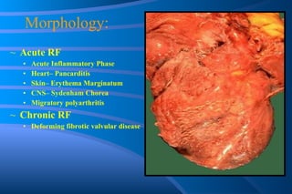 Morphology: Acute RF  Acute Inflammatory Phase Heart– Pancarditis Skin– Erythema Marginatum CNS– Sydenham Chorea Migratory polyarthritis Chronic RF Deforming fibrotic valvular disease 