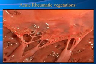 Acute Rheumatic vegetations: 